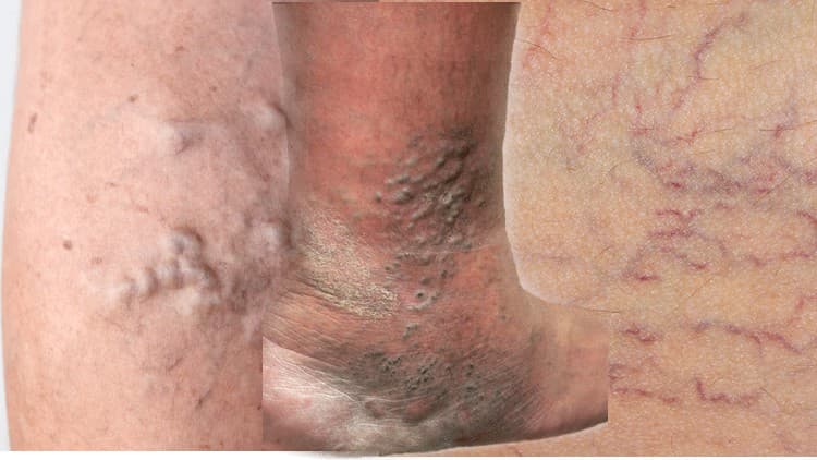 Varicose Veins Treatment - Free Udemy Course 100% Off