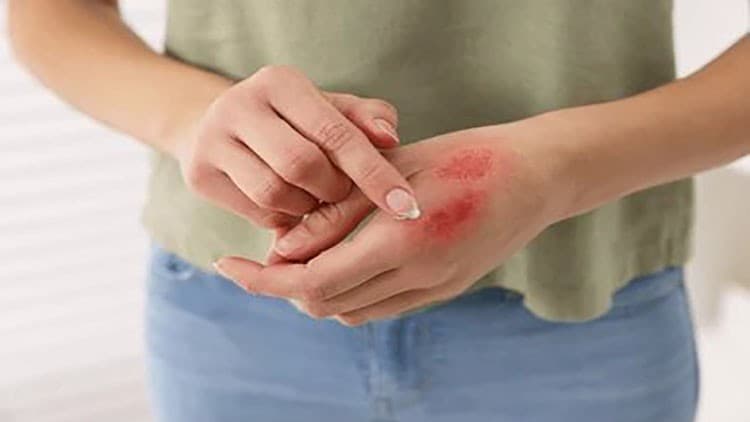 Beyond the Burn: Comprehensive Burn Care Strategies - Free Udemy Course 100% Off