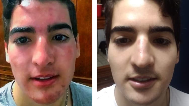 Acne: Effective Solution from the Root - Free Udemy Course 100% Off